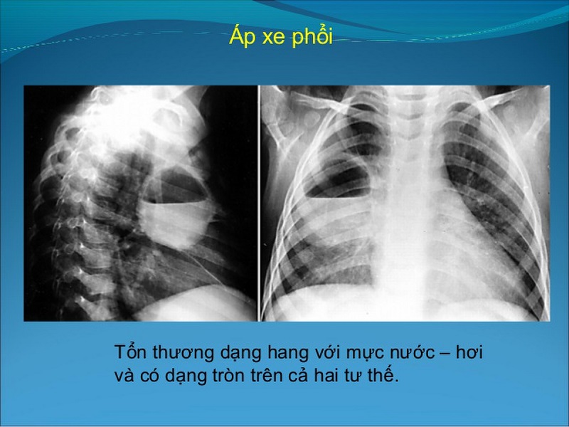 Áp xe phổi nguy hiểm không