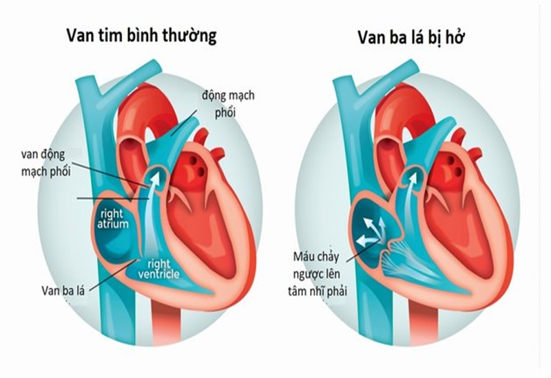 Hình ảnh siêu âm tim bệnh teo van ba lá
