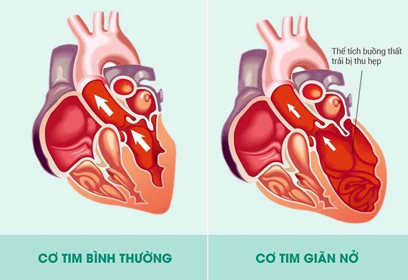 Bệnh cơ tim giãn - ảnh minh họa