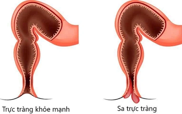Tổng quan về bệnh sa trực tràng