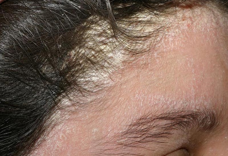 Hình ảnh người bị nấm da đầu