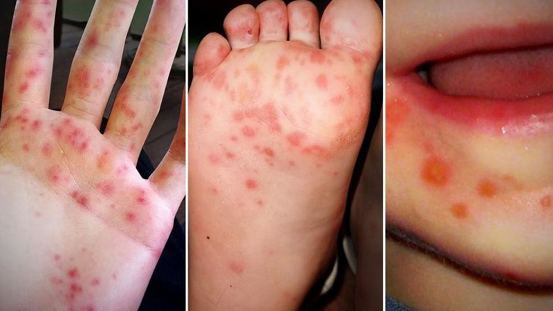 Mụn nước đặc trưng ở miệng trẻ mắc tay chân miệng