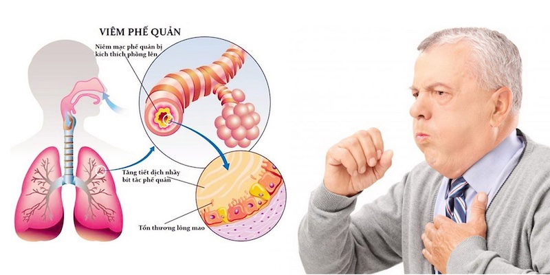 Viêm phế quản phổi là gì