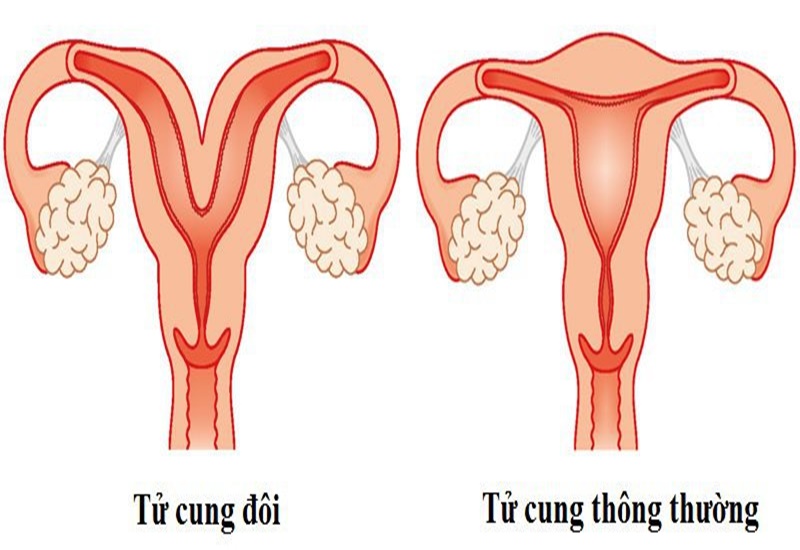 Minh họa tử cung đôi