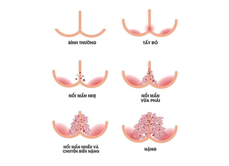 Dấu hiệu hăm da