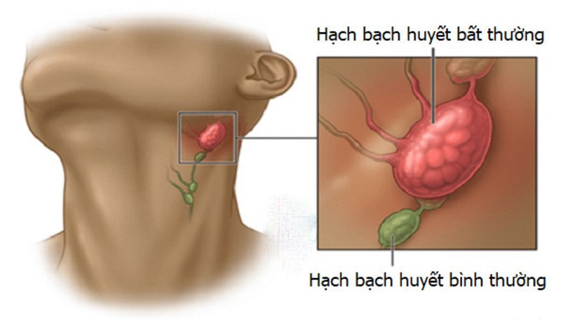 Hình ảnh CT ngực bệnh nhân LAM