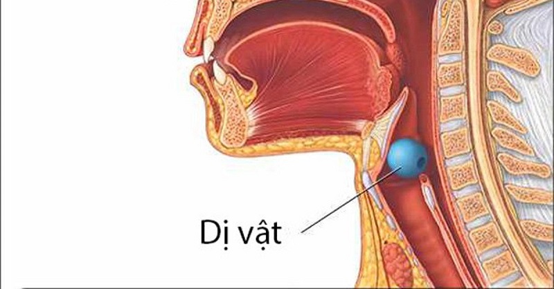 Cách lấy dị vật trong họng