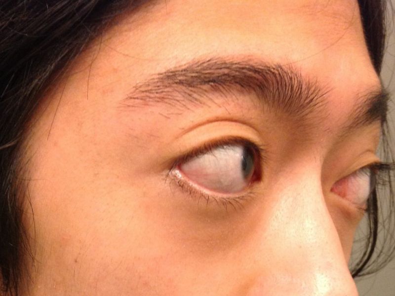 Lồi mắt ở bệnh nhân Basedow