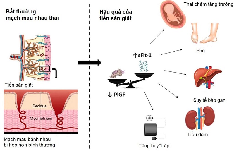 Xét nghiệm tiền sản giật