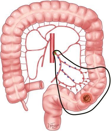 Vị trí đại tràng sigma trong hệ tiêu hóa