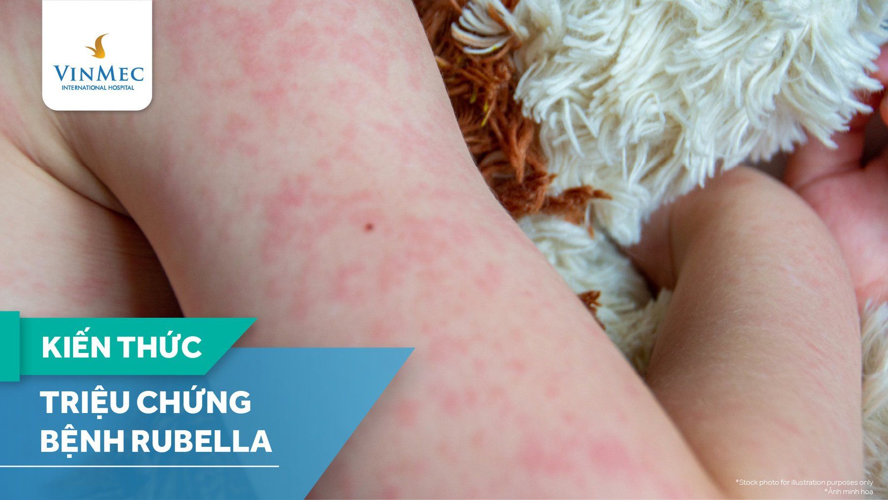 Phát ban do Rubella