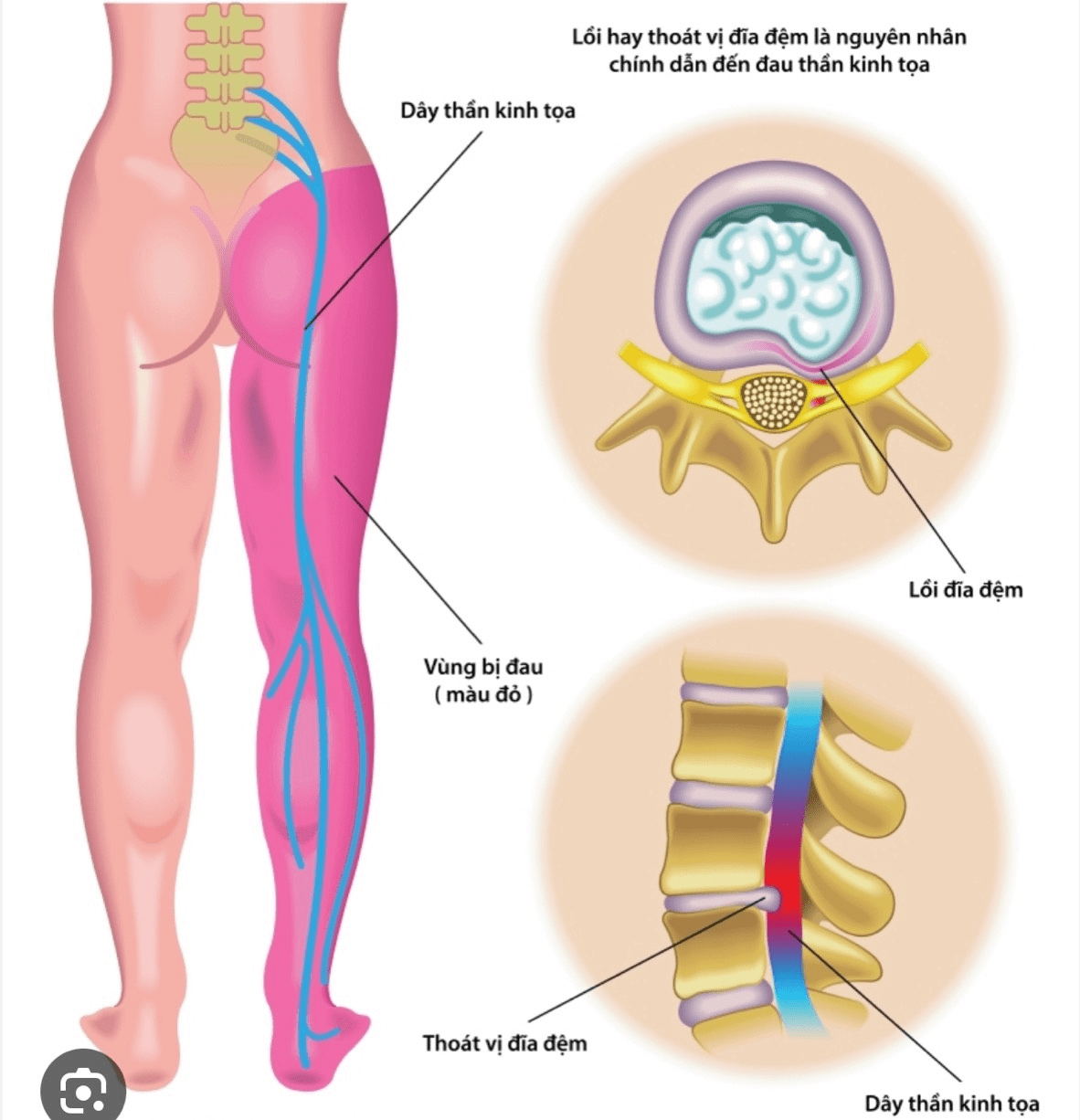 Cấu tạo đĩa đệm thắt lưng