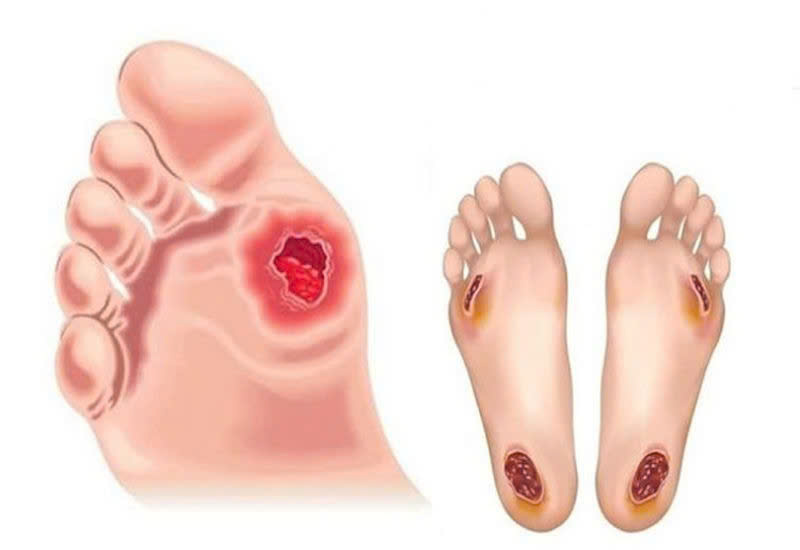 Phẫu thuật điều trị mô mềm hoại tử