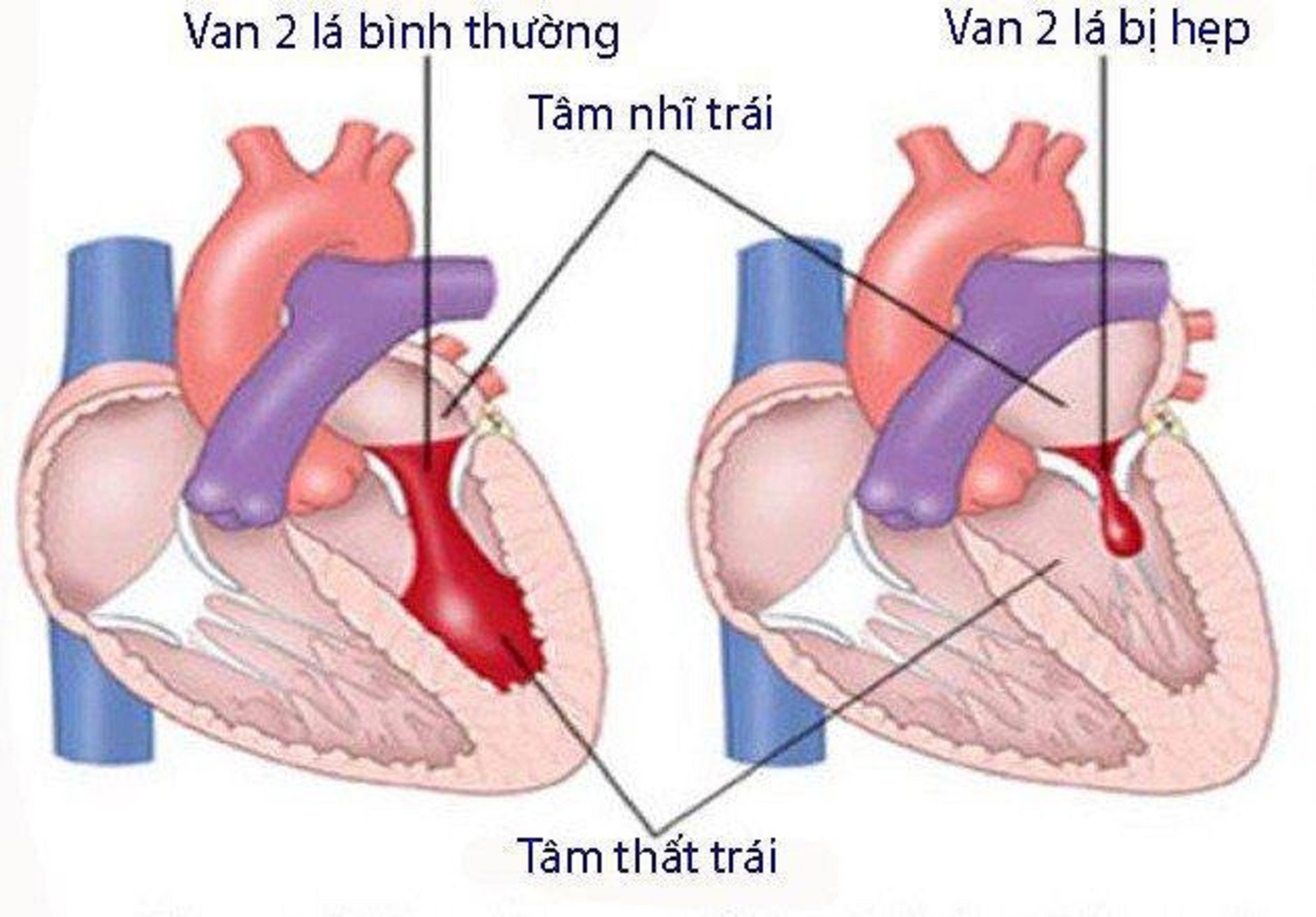 siêu âm tim hẹp van hai lá