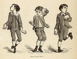Múa giật ở trẻ em