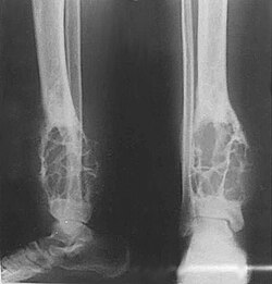 Adamantinoma: U Xương Hiếm Gặp Cần Được Chẩn Đoán Sớm 7 X-quang adamantinoma ở xương chày