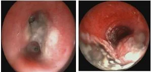 Aspergillus fumigatus dưới kính hiển vi