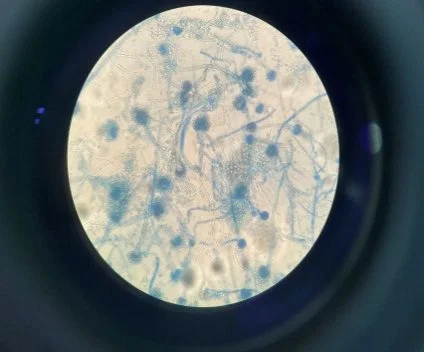 Nấm phổi Aspergillus hình ảnh CT scan