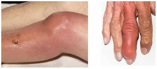 Hình ảnh siêu âm khớp nhiễm khuẩn