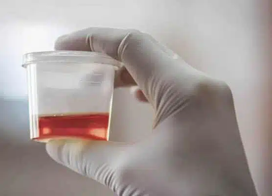 Hình ảnh nước tiểu có máu đại thể