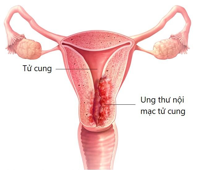 Hình ảnh nội soi tử cung phát hiện ung thư