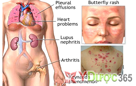 Lupus ảnh hưởng đến phổi