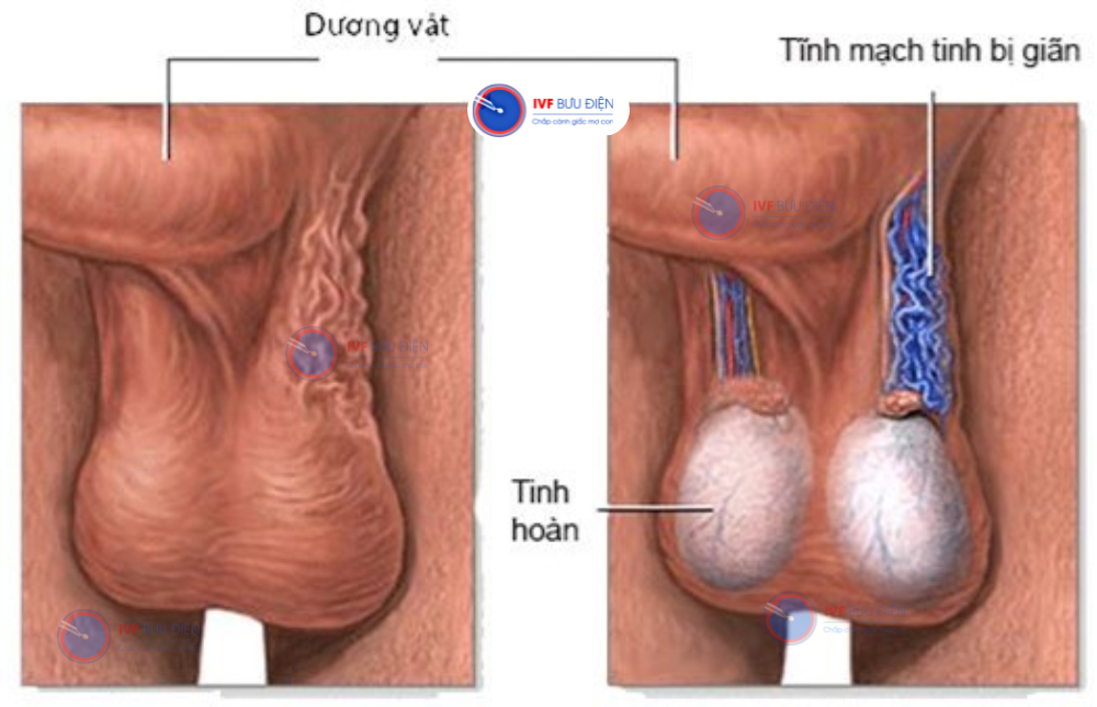 Phân loại giãn tĩnh mạch thừng tinh