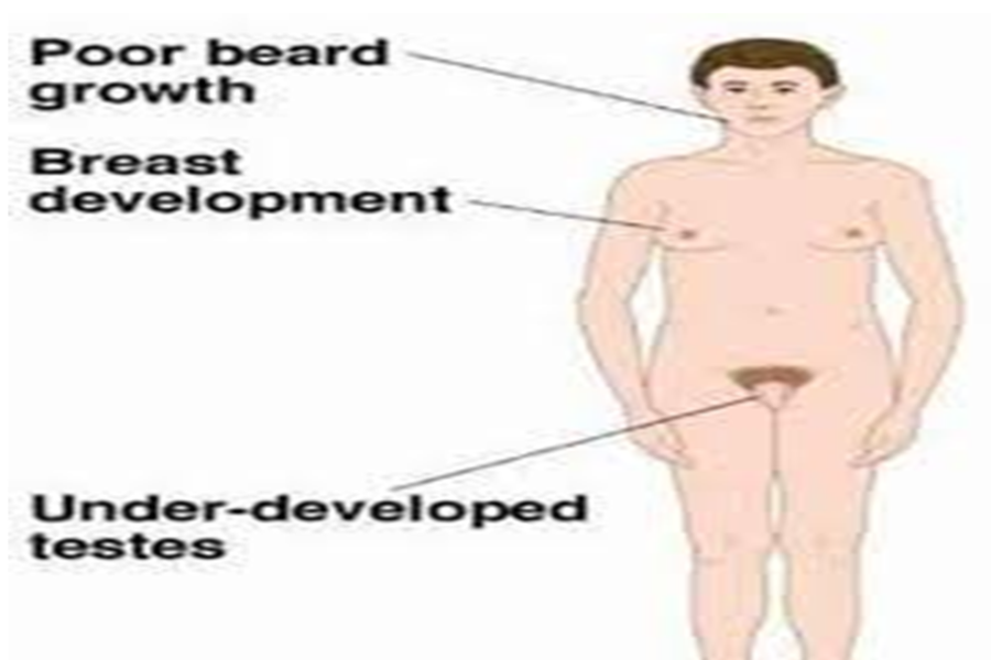 Ba thể hội chứng không nhạy cảm với androgen