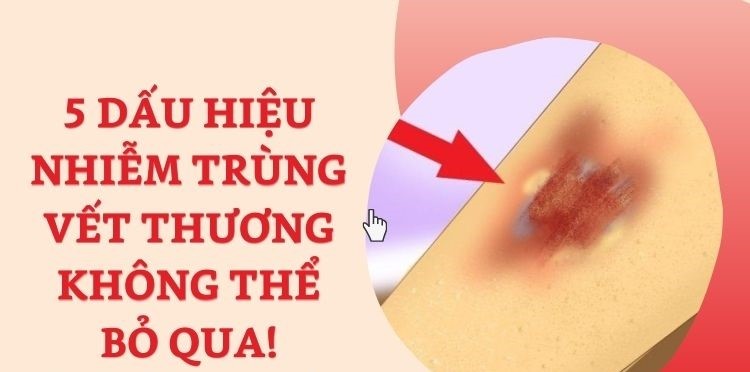Vết thương nhiễm trùng mưng mủ