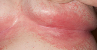 Yếu tố thuận lợi khiến Candida phát triển