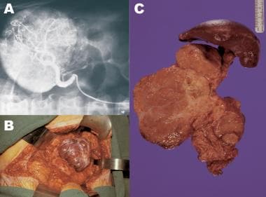 Hình ảnh CT scan u tụy VIPoma