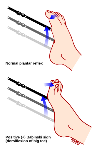 So sánh phản xạ bình thường và Babinski