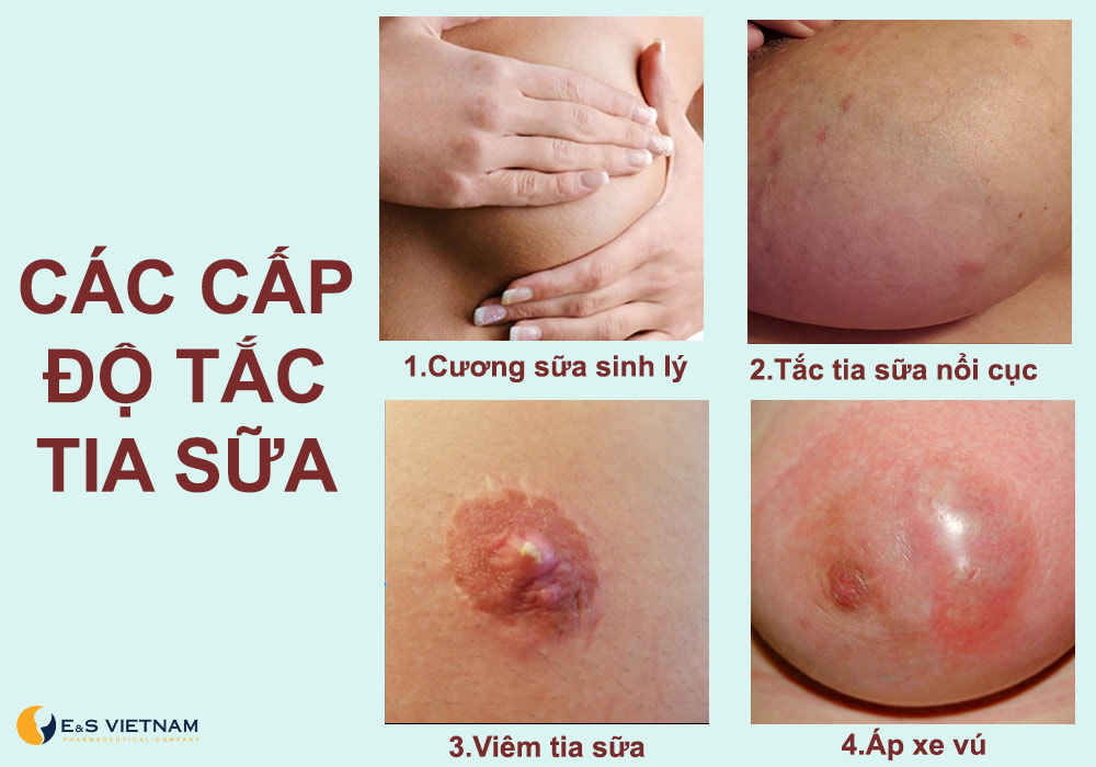 Các cấp độ tắc tia sữa