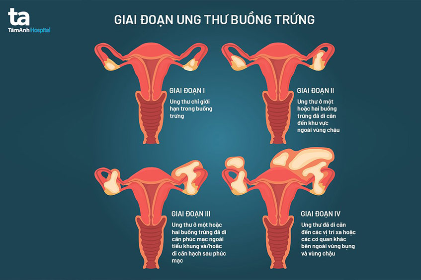 Các giai đoạn ung thư buồng trứng