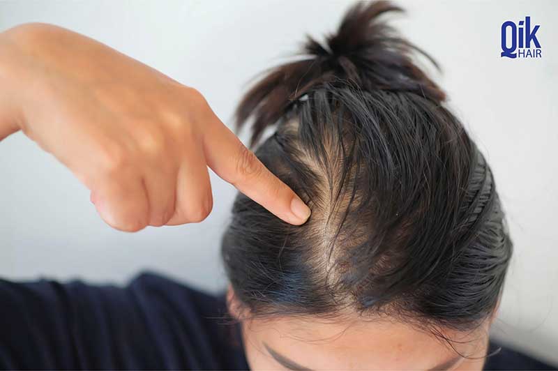 Biến chứng hói đầu do Trichotillomania