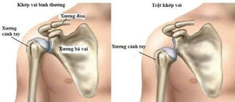 Trật khớp vai do chơi thể thao