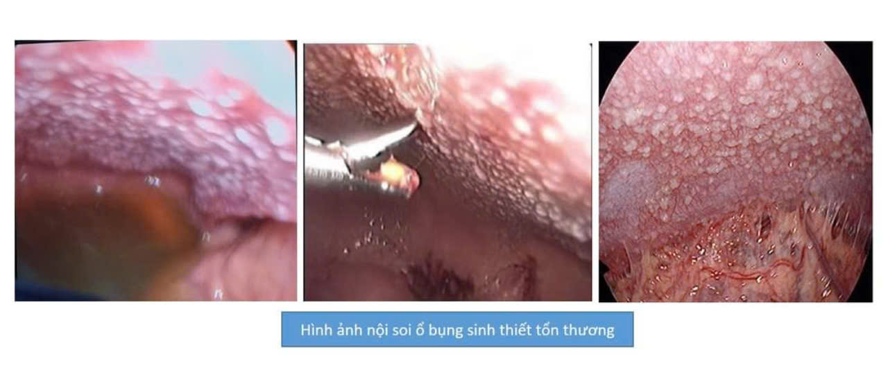 Lao Màng Bụng: Triệu Chứng, Nguyên Nhân, Chẩn Đoán và Cách Điều Trị 8 Siêu âm chẩn đoán lao màng bụng