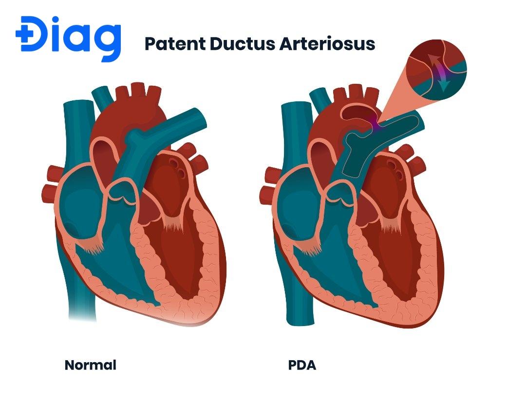 dị tật PDA ở trẻ sơ sinh