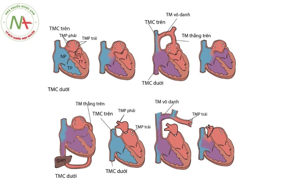 Bất thường tĩnh mạch phổi trở về hoàn toàn/bán phần: Dị tật tim hiếm gặp và những điều cần biết 8 Giải phẫu bất thường tĩnh mạch phổi