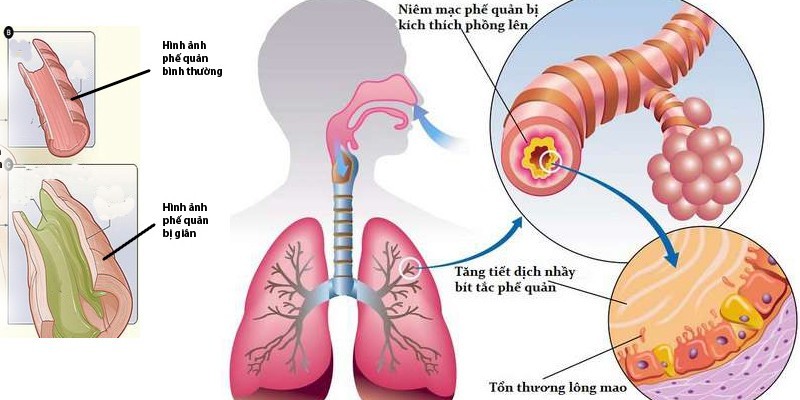Nguyên nhân gây giãn phế quản