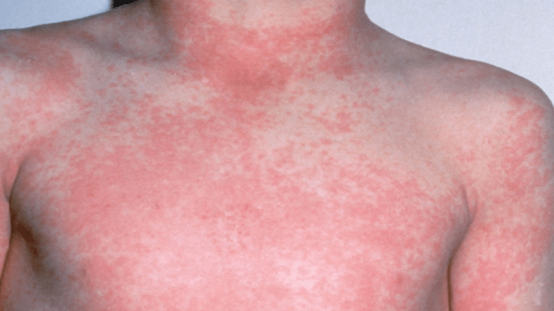 Các triệu chứng thường gặp của bệnh thương hàn
