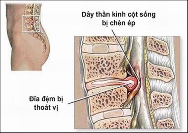 Triệu chứng đau lan xuống chân