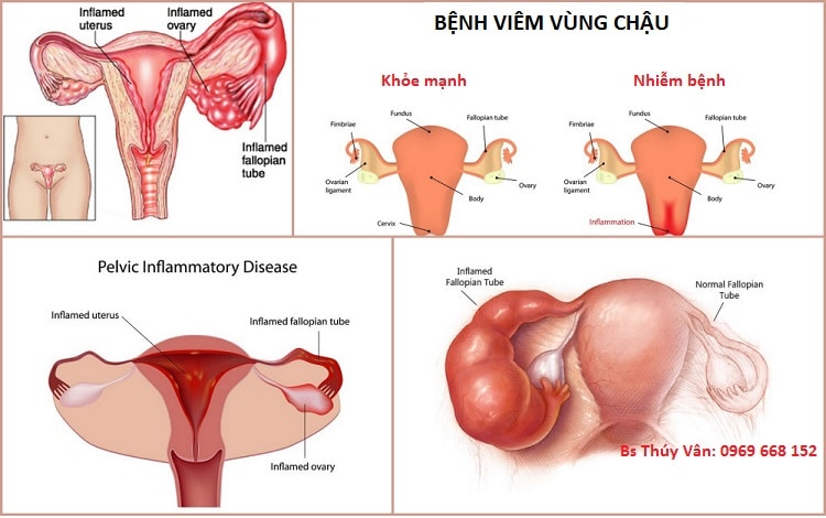 Minh họa viêm vùng chậu