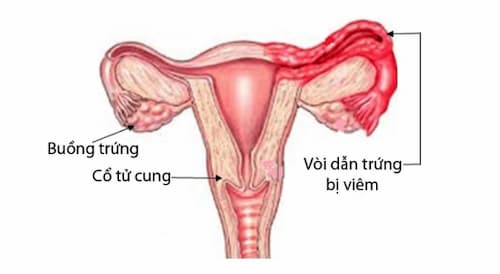Hình ảnh minh họa viêm vòi trứng