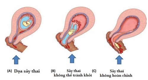 Hình ảnh minh họa về sảy thai
