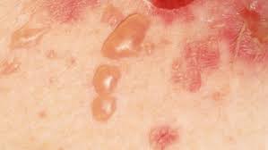 Pemphigus sùi hình ảnh tổn thương da