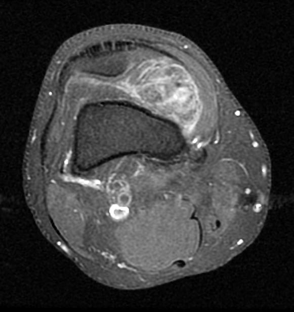 Sarcoma màng hoạt dịch: Triệu chứng, chẩn đoán và điều trị hiệu quả 8 MRI khối u sarcoma màng hoạt dịch