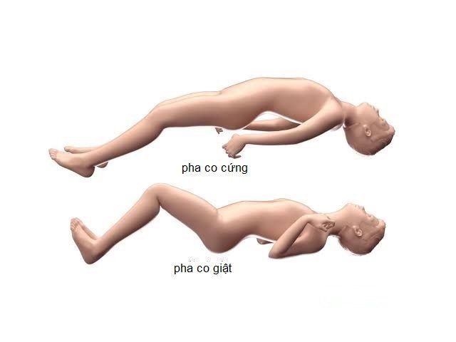 Triệu chứng co cứng co giật