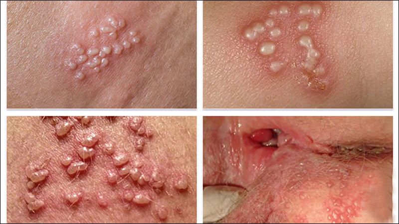 Triệu chứng mụn rộp sinh dục