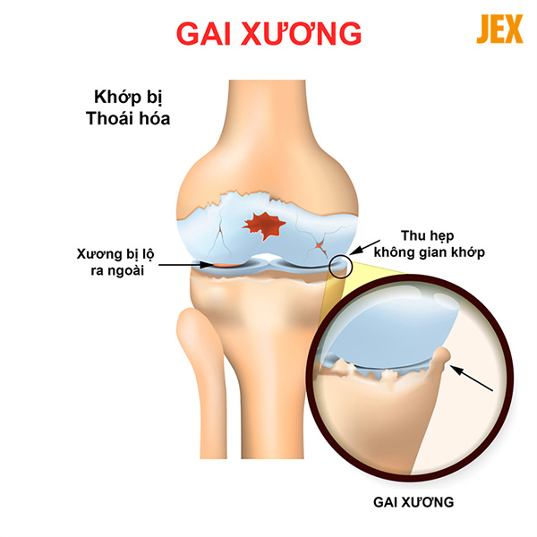 So sánh khớp gối bình thường và khớp có gai